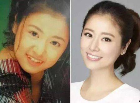 女明星牙齿整容前后,女明星牙齿整容前后对比解析